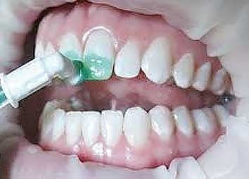 ICON - лечение кариеса без препарирования